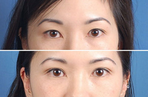 блефаропластика азиатских глаз до и после фото